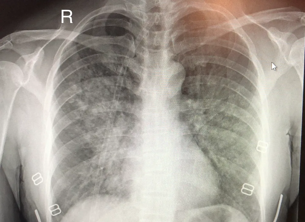 Xray of HAPE Patient
